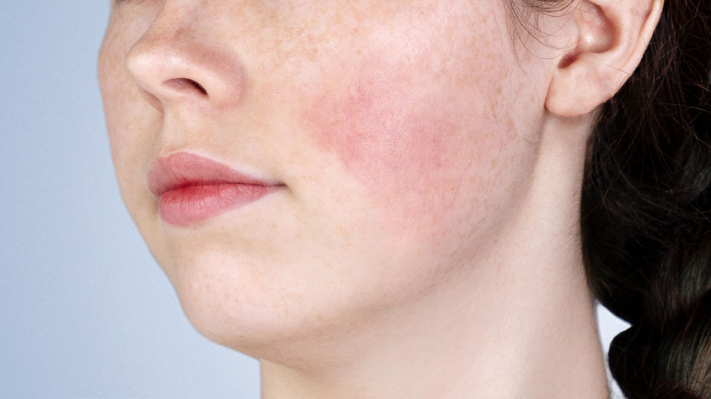 Comprendre votre peau : qu'est-ce qui cause les rougeurs cutanées ?